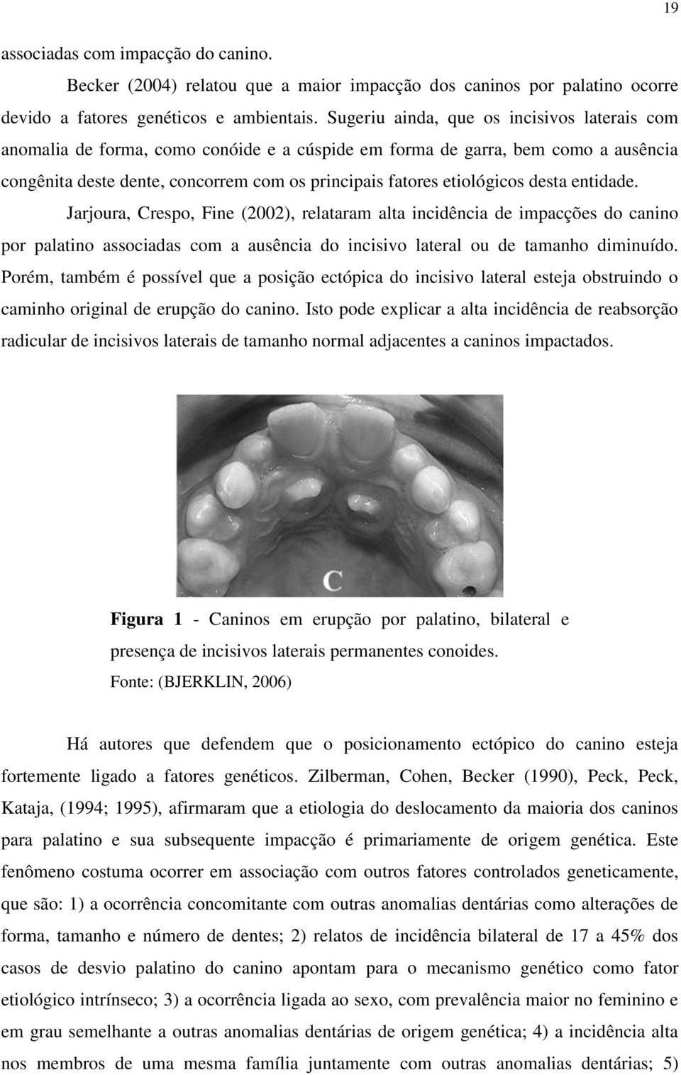 desta entidade. Jarjoura, Crespo, Fine (2002), relataram alta incidência de impacções do canino por palatino associadas com a ausência do incisivo lateral ou de tamanho diminuído.