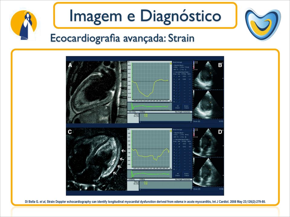 et al, Strain Doppler echocardiography can identify