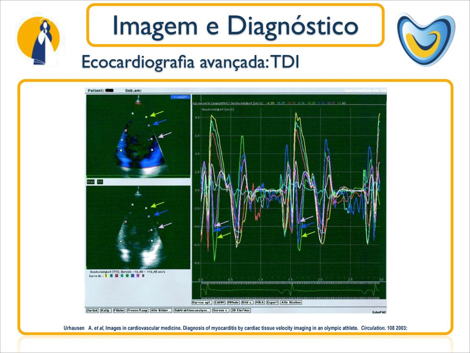 Diagnosis of myocarditis by cardiac tissue velocity