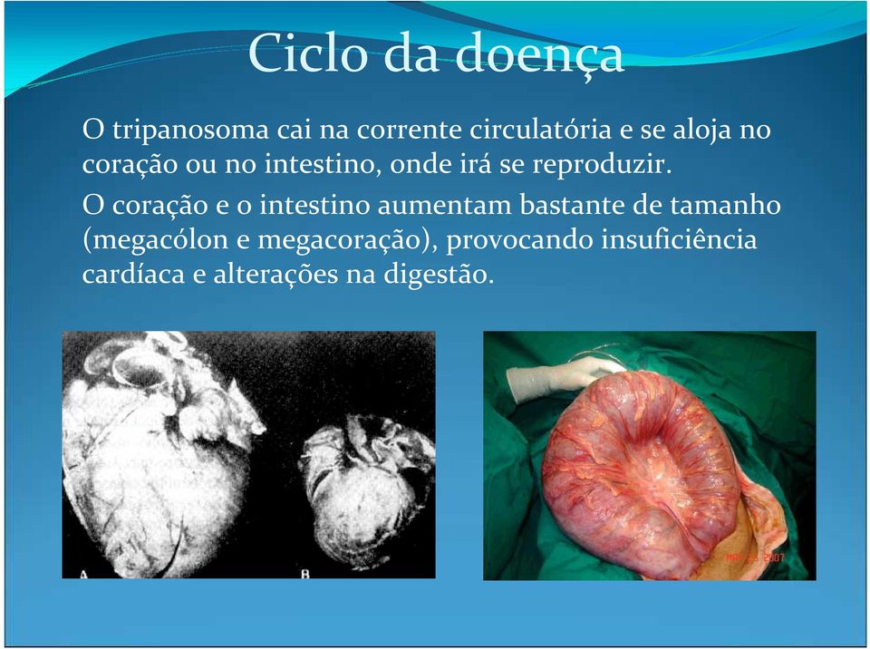 O coração e o intestino aumentam bastante de tamanho (megacólon e