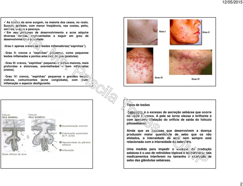 - Grau II: cravos e espinhas pequenas, como pequenas lesões inflamadas e pontos amarelos de pus (pústulas).