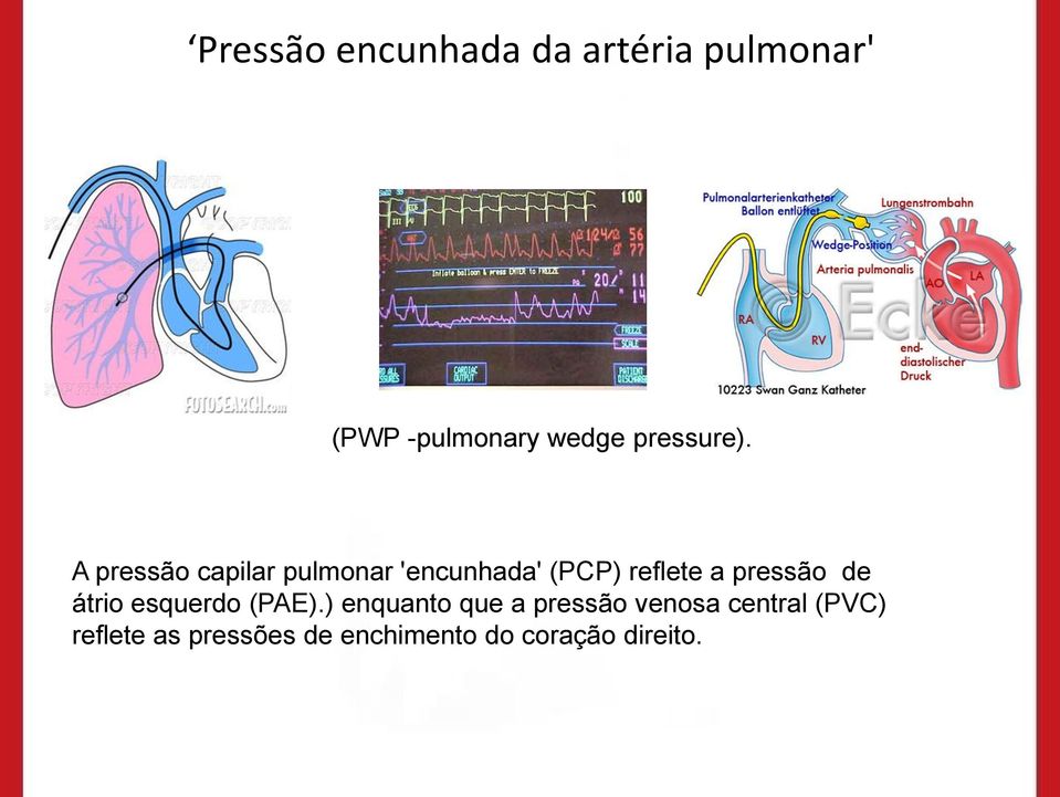 A pressão capilar pulmonar 'encunhada' (PCP) reflete a pressão