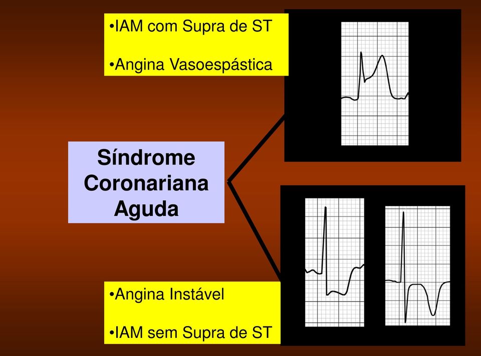 Síndrome Coronariana