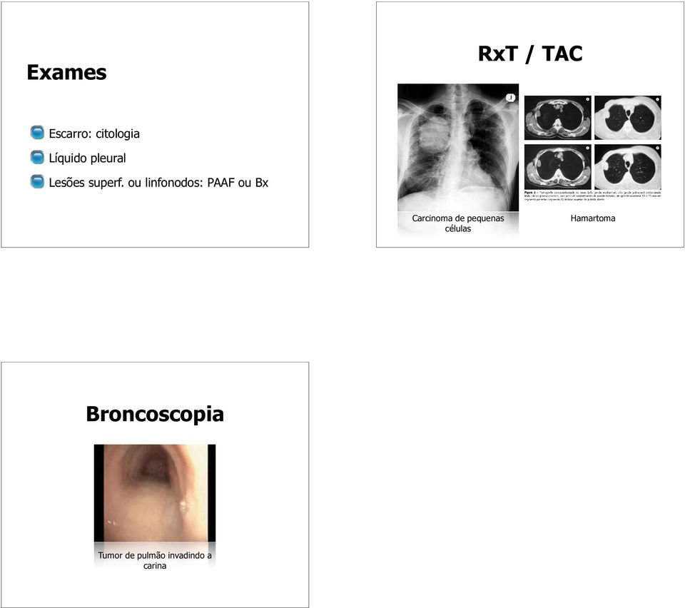 ou linfonodos: PAAF ou Bx Carcinoma de