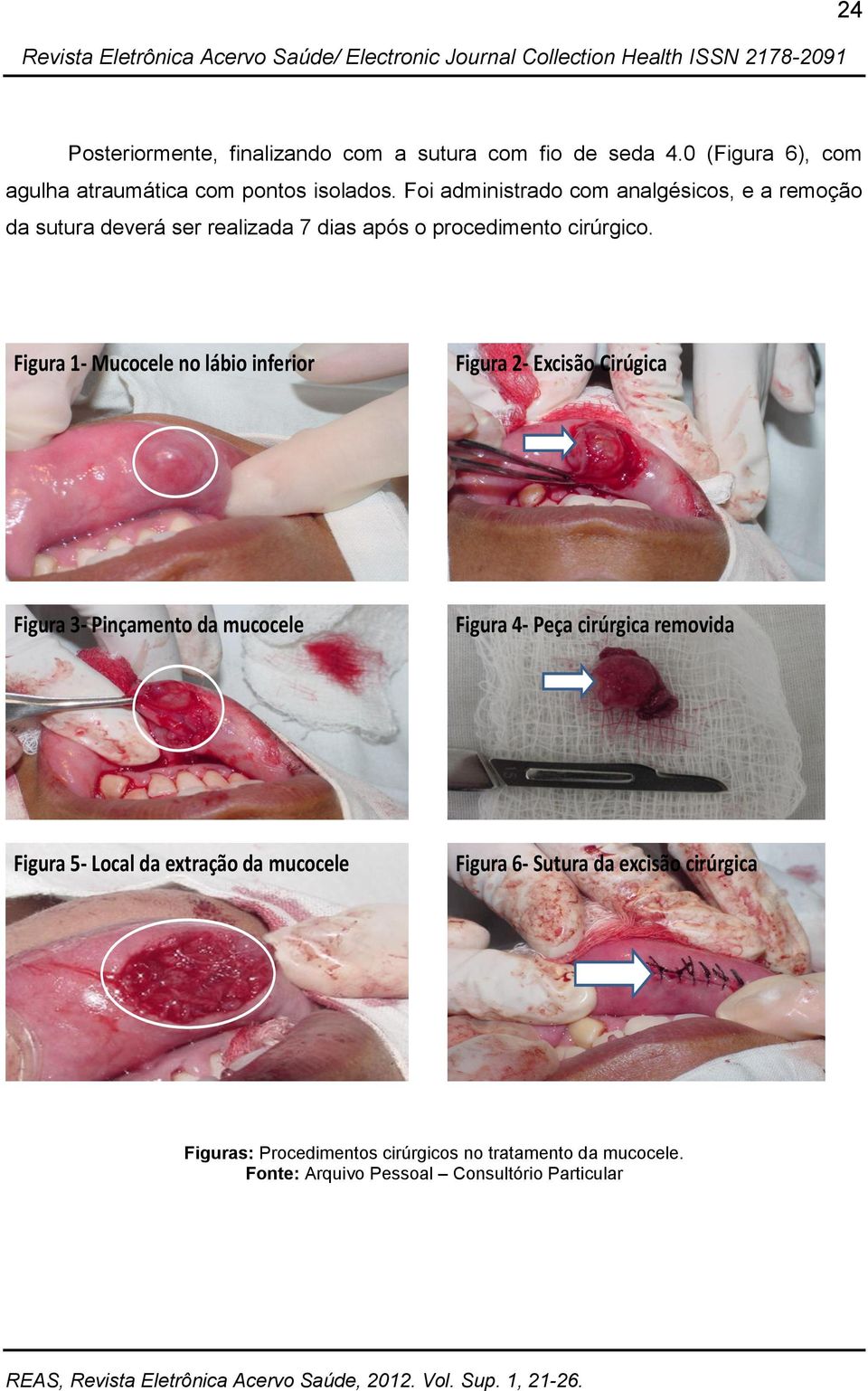 Figura 1- Mucocele no lábio inferior Figura 2- Excisão Cirúgica Figura 3- Pinçamento da mucocele Figura 4- Peça cirúrgica removida Figura