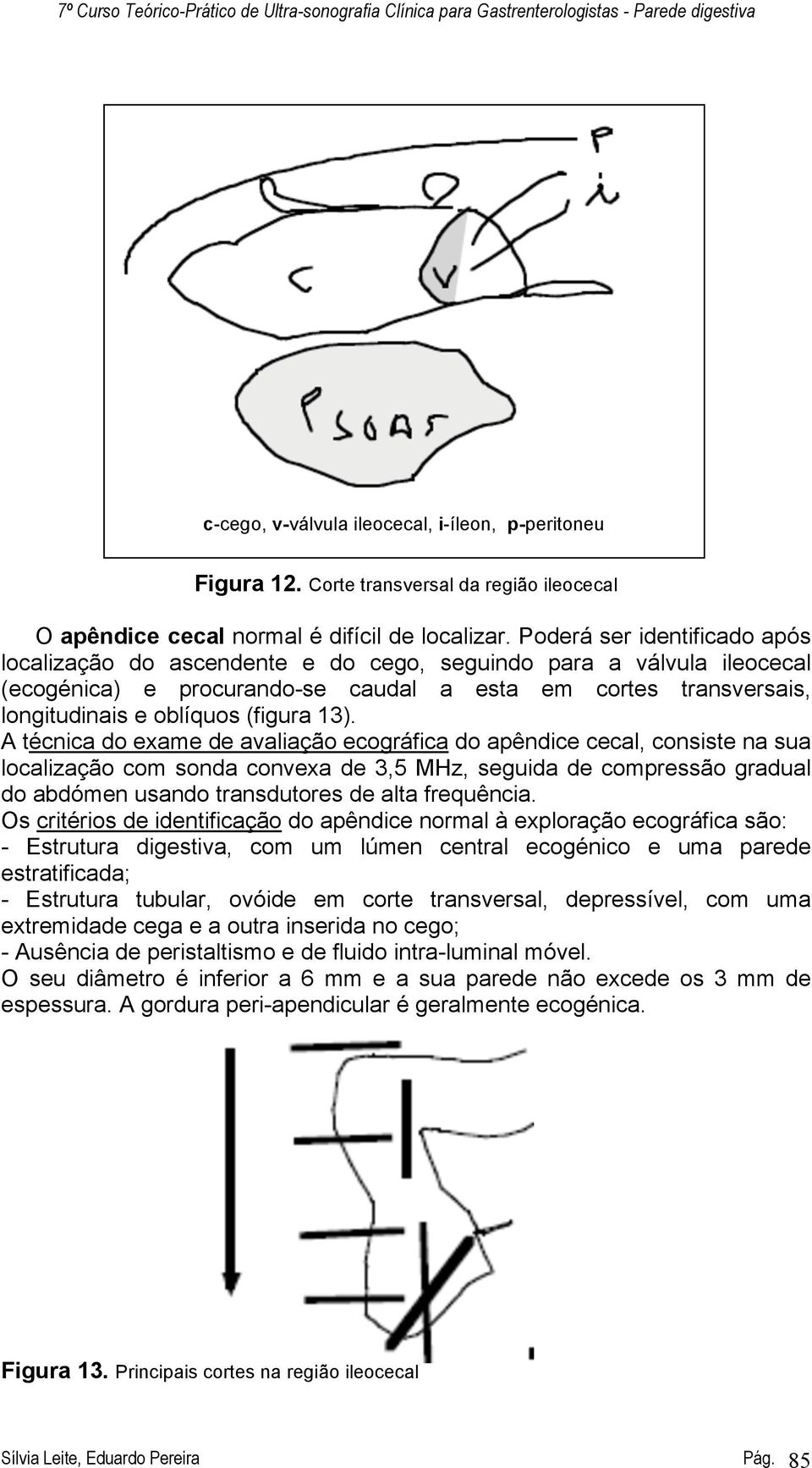 13). A técnica do exame de avaliação ecográfica do apêndice cecal, consiste na sua localização com sonda convexa de 3,5 MHz, seguida de compressão gradual do abdómen usando transdutores de alta