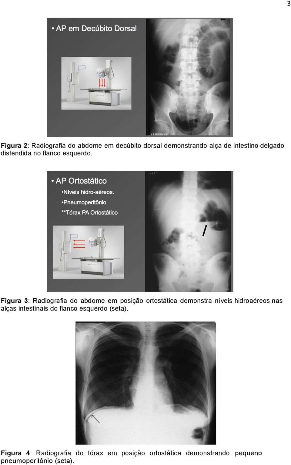 Figura 3: Radiografia do abdome em posição ortostática demonstra níveis hidroaéreos nas