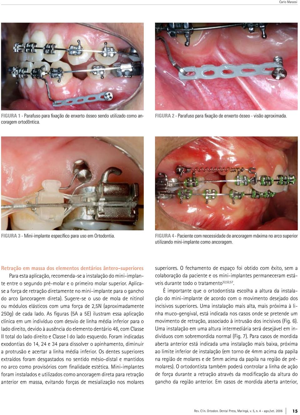 Retração em massa dos elementos dentários ântero-superiores Para esta aplicação, recomenda-se a instalação do mini-implante entre o segundo pré-molar e o primeiro molar superior.