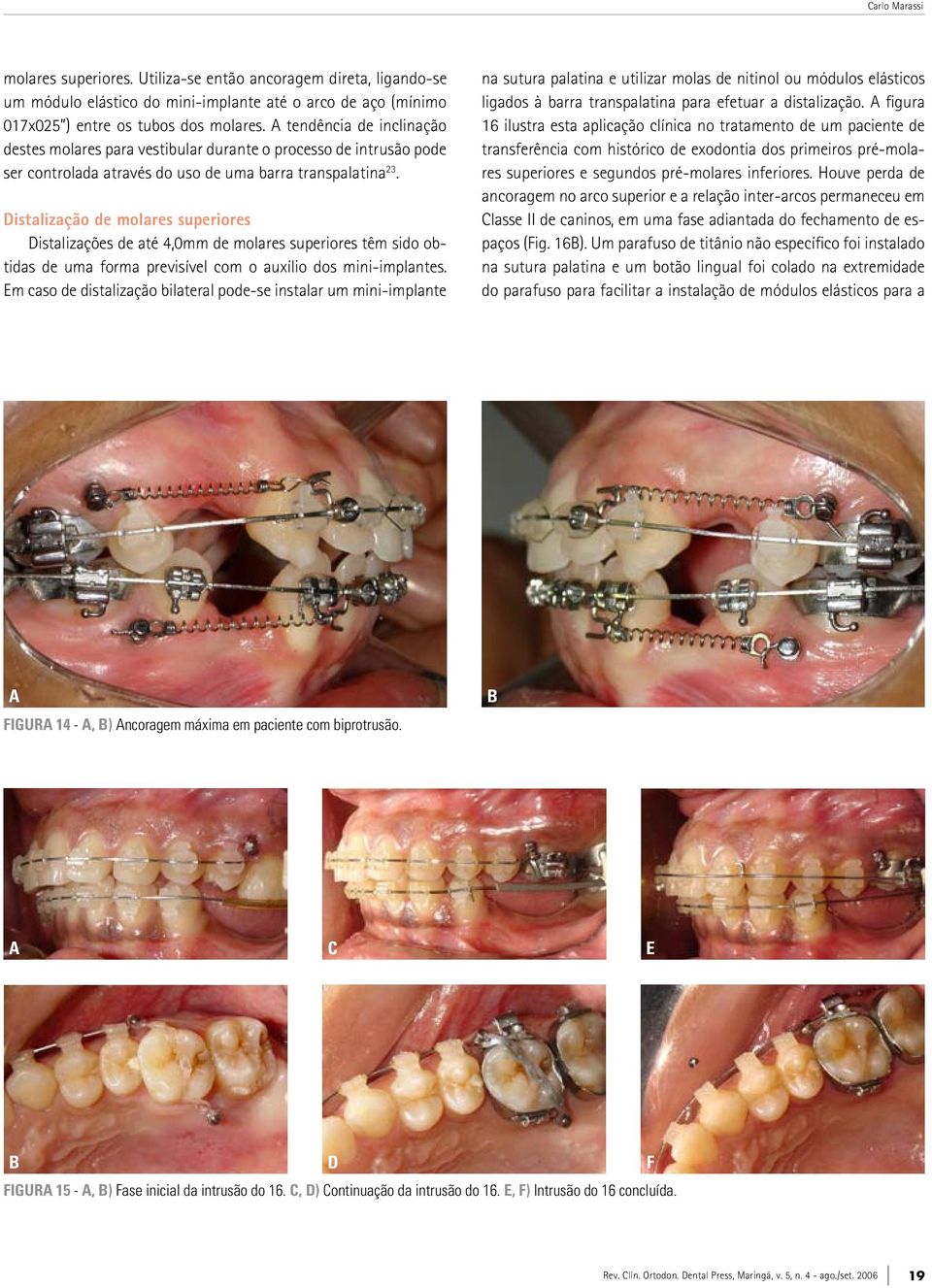 Distalização de molares superiores Distalizações de até 4,0mm de molares superiores têm sido otidas de uma forma previsível com o auxílio dos mini-implantes.