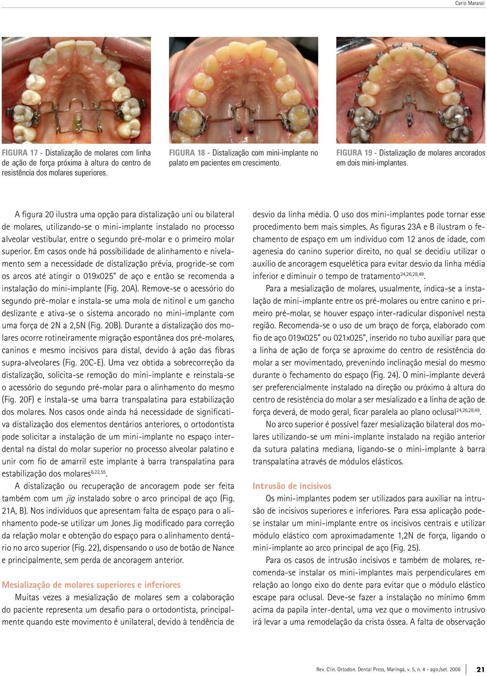 figura 20 ilustra uma opção para distalização uni ou ilateral de molares, utilizando-se o mini-implante instalado no processo alveolar vestiular, entre o segundo pré-molar e o primeiro molar superior.