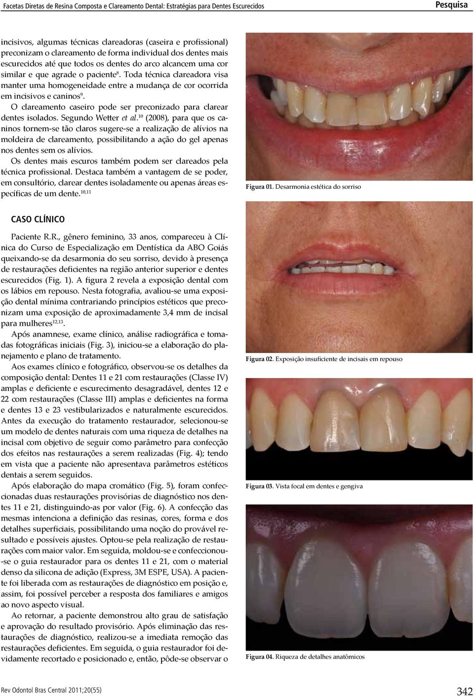 O clareamento caseiro pode ser preconizado para clarear dentes isolados. Segundo Wetter et al.