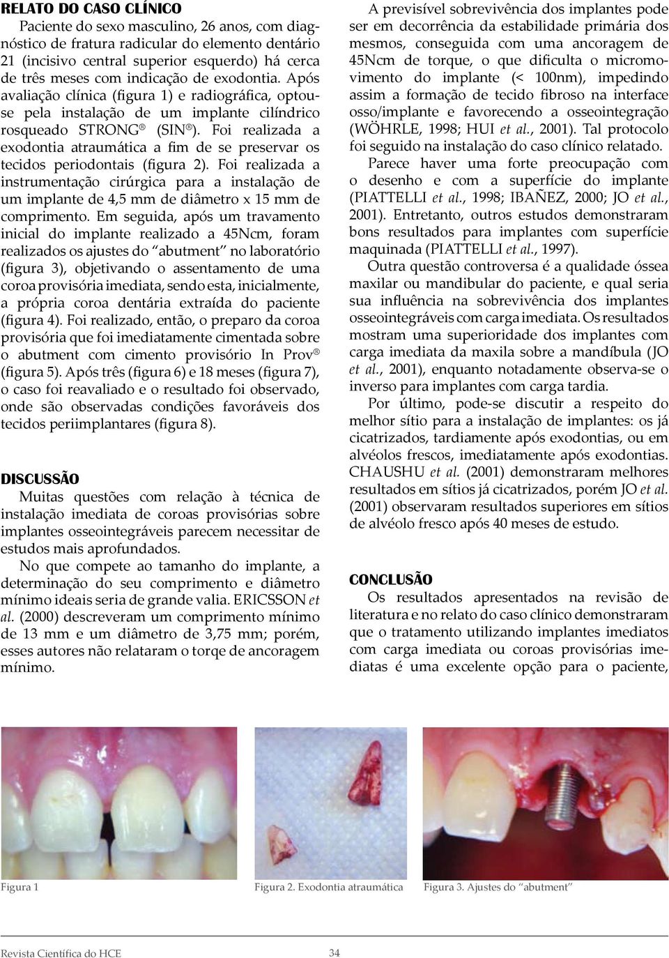 Foi realizada a exodontia atraumática a fim de se preservar os tecidos periodontais (figura 2).