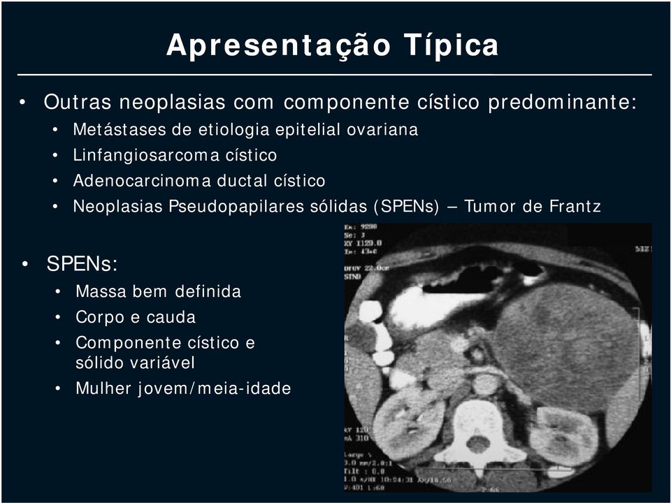 ductal cístico Neoplasias Pseudopapilares sólidas (SPENs) Tumor de Frantz SPENs: