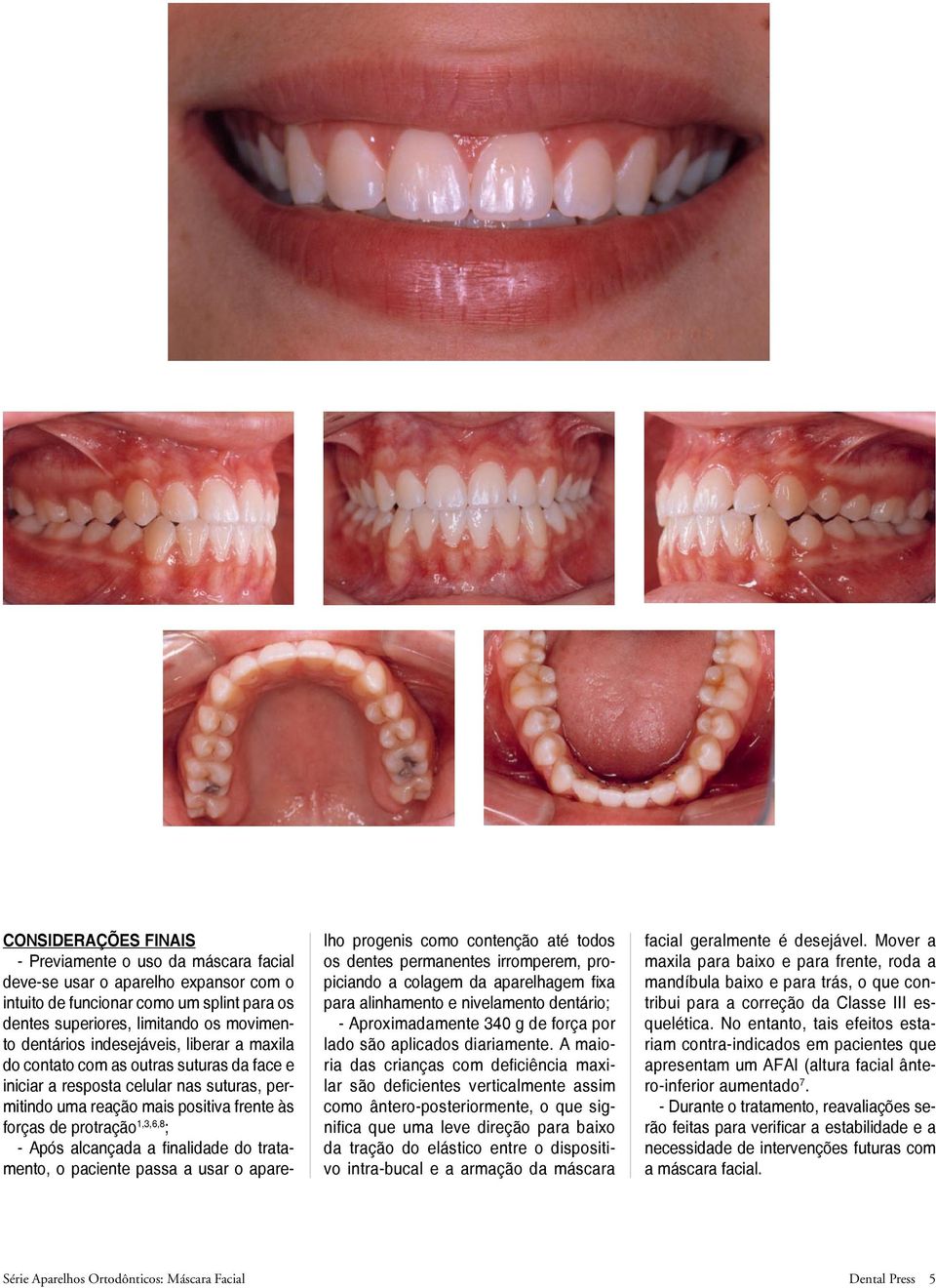 alcançada a finalidade do tratamento, o paciente passa a usar o aparelho progenis como contenção até todos os dentes permanentes irromperem, propiciando a colagem da aparelhagem fixa para alinhamento