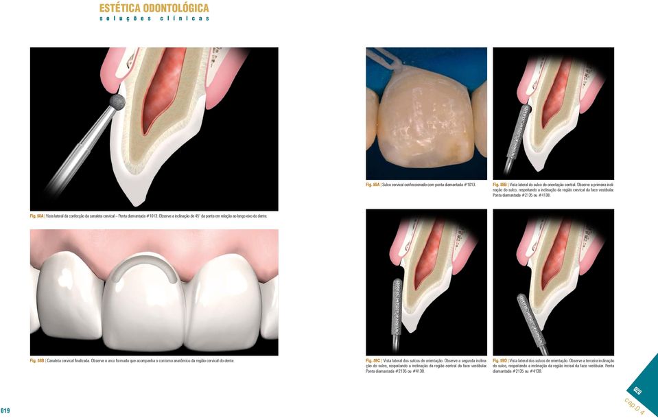 58A Vista lateral da confecção da canaleta cervical Ponta diamantada #1013. Observe a inclinação de 45 da ponta em relação ao longo eixo do dente. Fig. 58B Canaleta cervical finalizada.