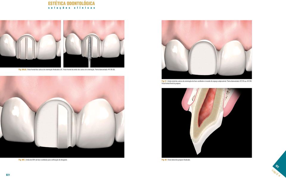 61 União total dos sulcos de orientação da face vestibular e invasão do espaço subproximal.