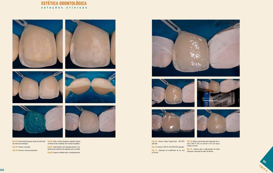 Fig. 69 Adesivo Adper Single Bond - 3M ESPE aplicado. Fig. 70 Resina Z-350 XT A2D 3M-ESPE aplicada. Fig. 71 Aplicação do modificador de cor azul na incisal. Fig. 72 Matriz posicionada após aplicação da resina Z-350 XT A2E na cervical e A1E nos terços médios e incisal.