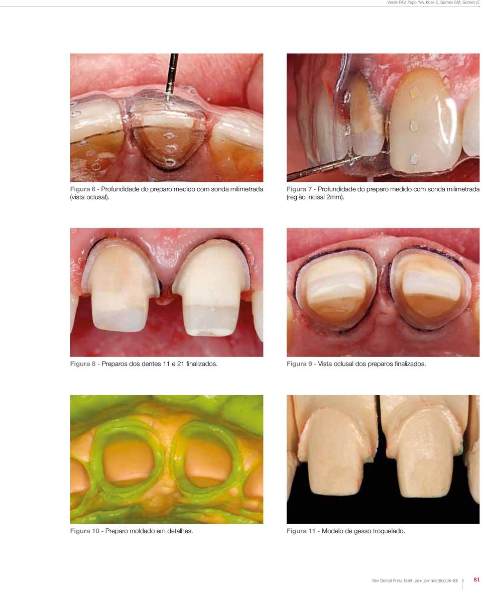 Figura 8 - Preparos dos dentes 11 e 21 finalizados. Figura 9 - Vista oclusal dos preparos finalizados.