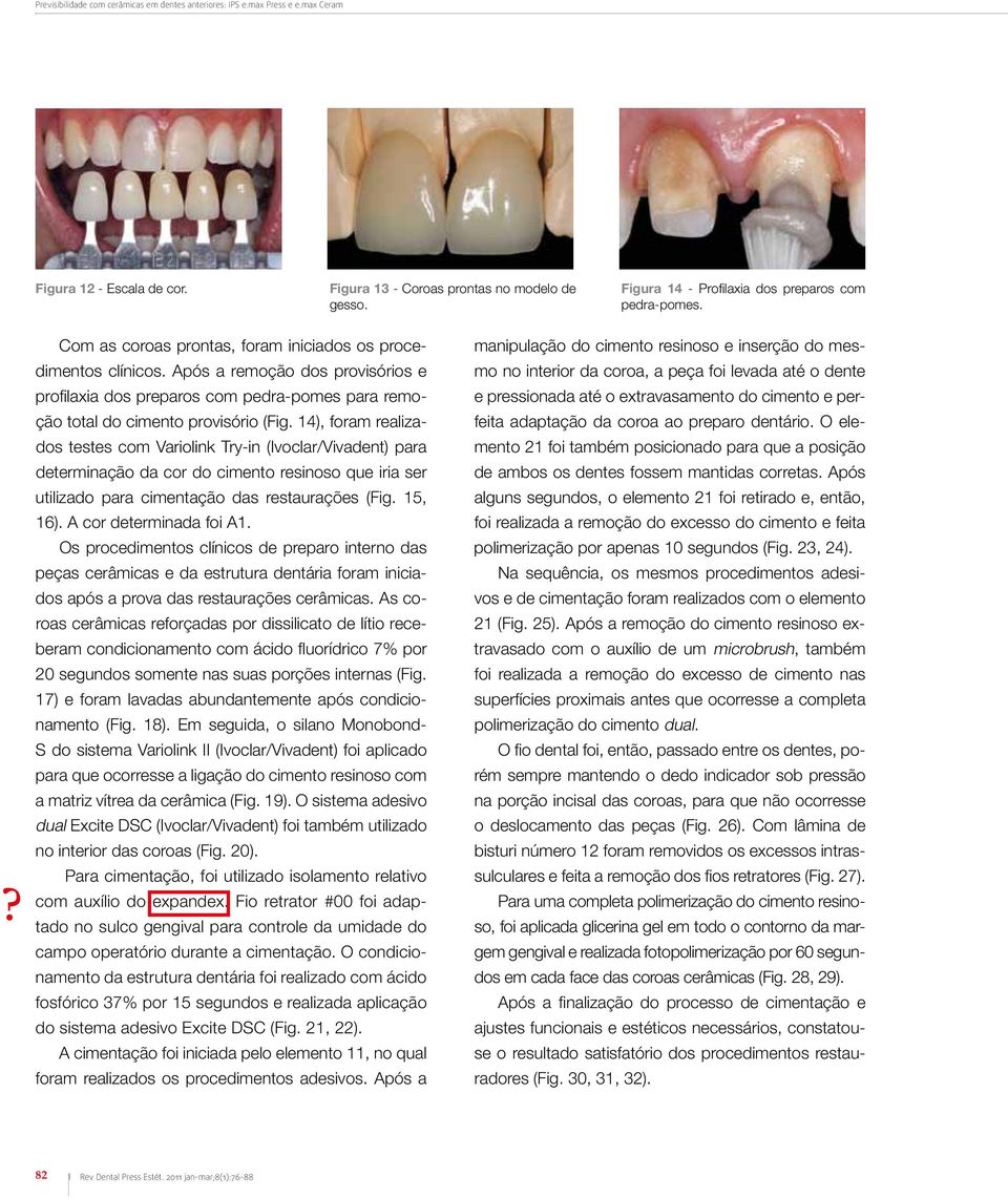 Após a remoção dos provisórios e profilaxia dos preparos com pedra-pomes para remoção total do cimento provisório (Fig.