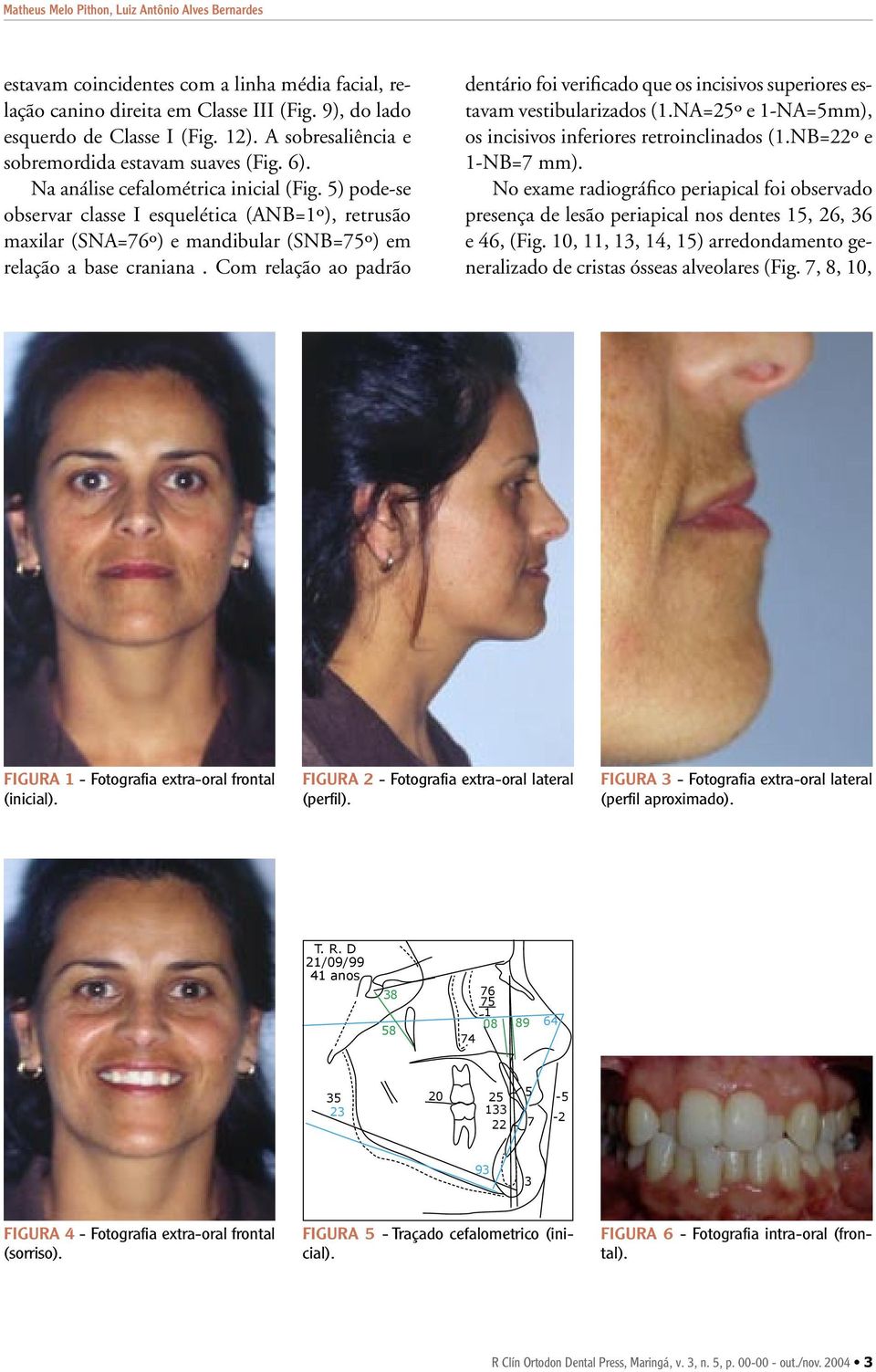5) pode-se observar classe I esquelética (ANB=1º), retrusão maxilar (SNA=76º) e mandibular (SNB=75º) em relação a base craniana.