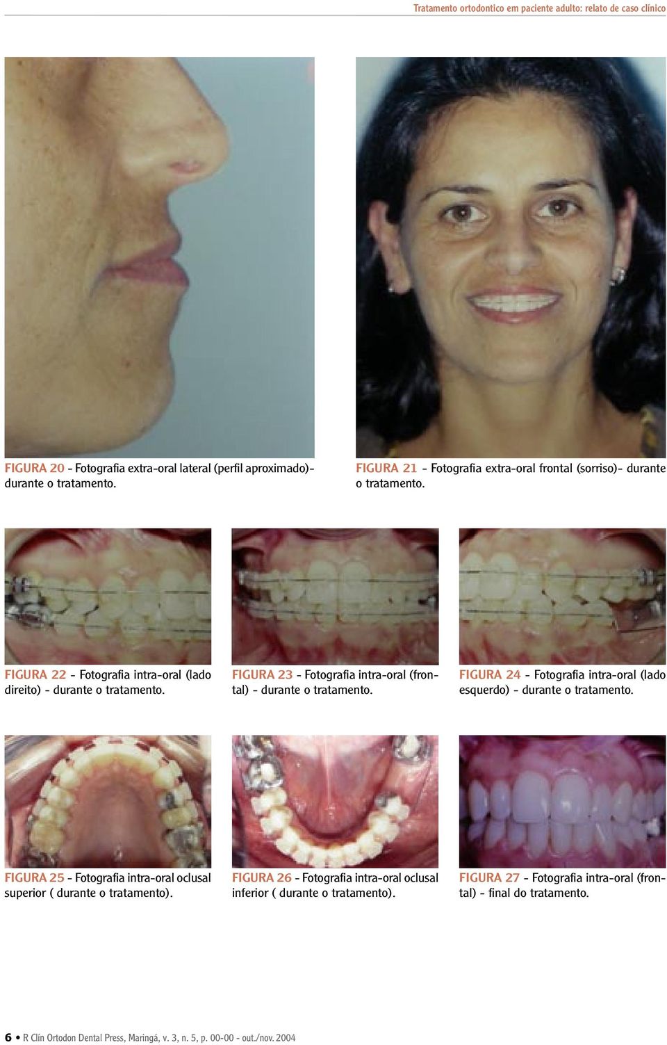 FIGURA 23 - Fotografia intra-oral (frontal) - durante o tratamento. FIGURA 24 - Fotografia intra-oral (lado esquerdo) - durante o tratamento.