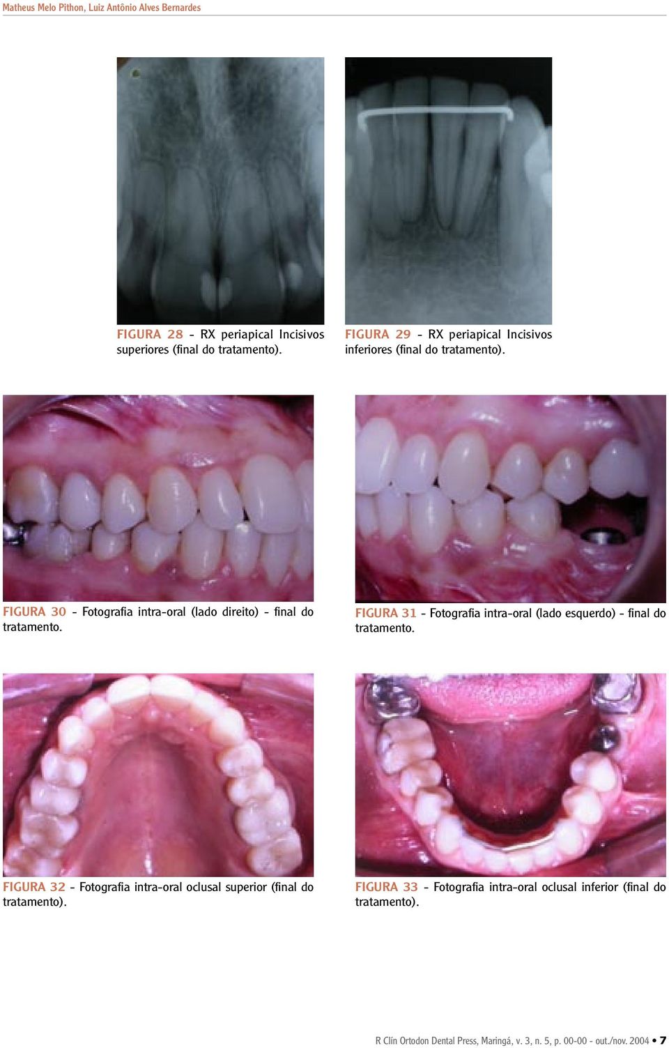 FIGURA 30 - Fotografia intra-oral (lado direito) - final do tratamento.