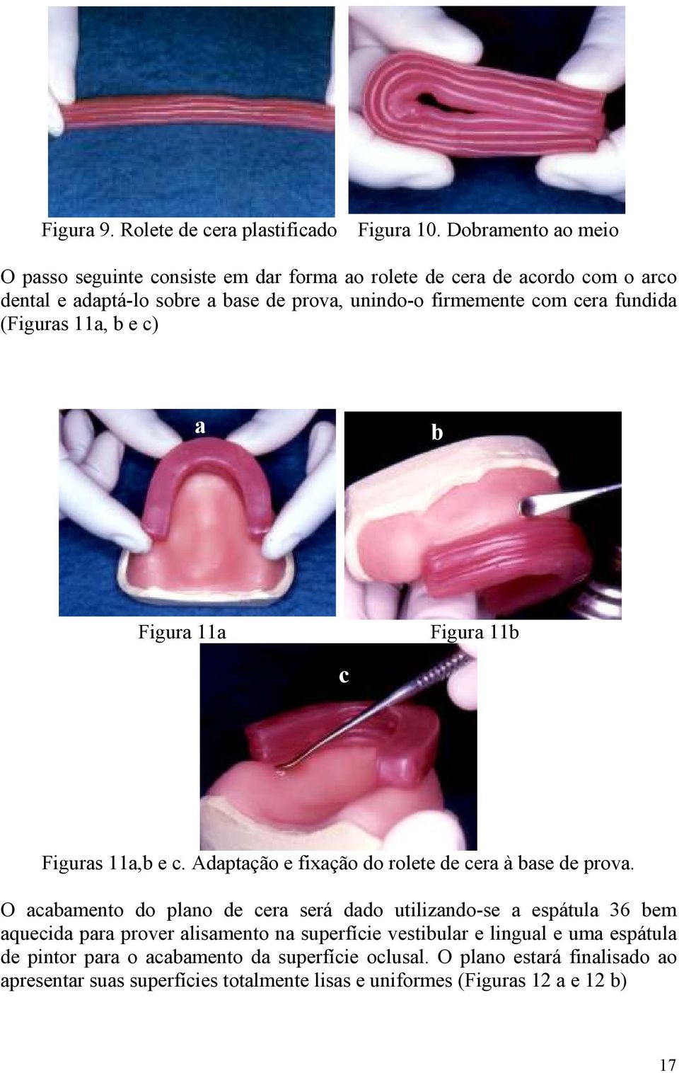 cera fundida (Figuras 11a, b e c) a b Figura 11a Figura 11b c Figuras 11a,b e c. Adaptação e fixação do rolete de cera à base de prova.