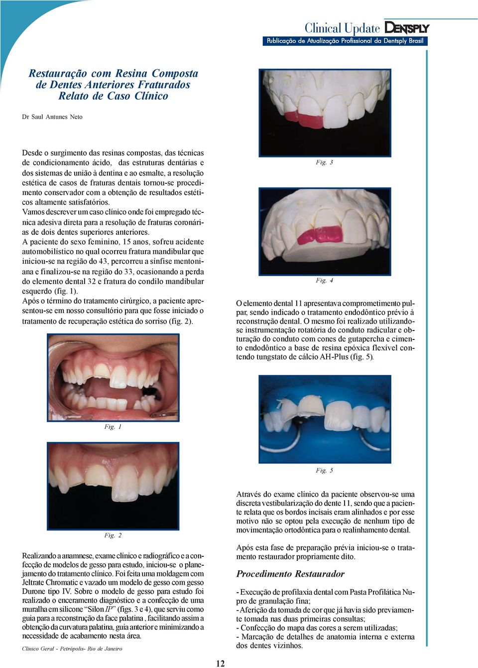 altamente satisfatórios. Vamos descrever um caso clínico onde foi empregado técnica adesiva direta para a resolução de fraturas coronárias de dois dentes superiores anteriores.