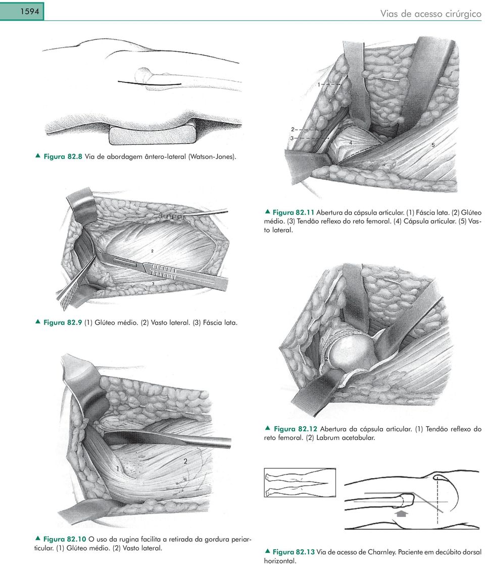 Figura 82.12 Abertura da cápsula articular. (1) Tendão reflexo do reto femoral. (2) Labrum acetabular. 1 2 Figura 82.