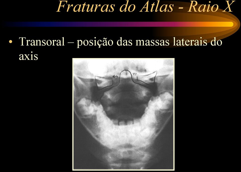 Transoral posição