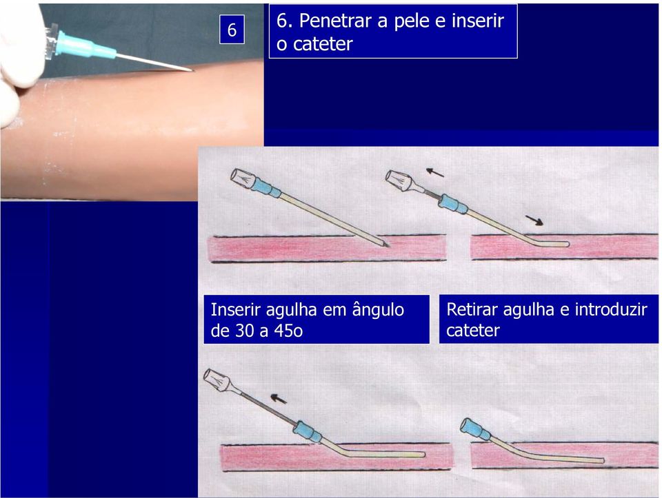 agulha em ângulo de 30 a 45o