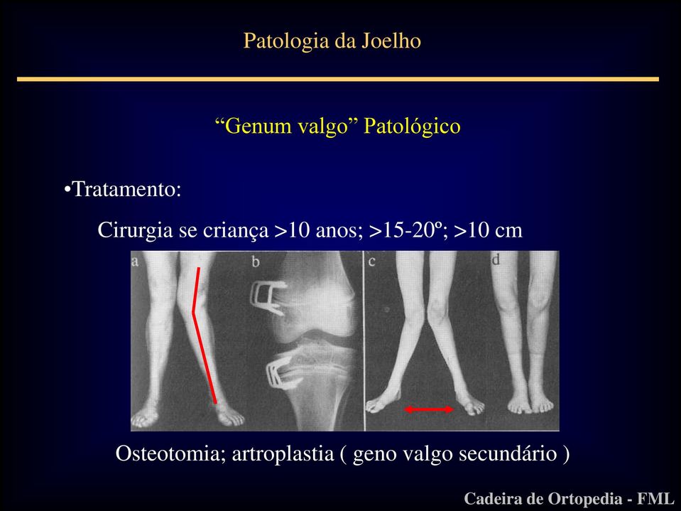 >10 anos; >15-20º; >10 cm