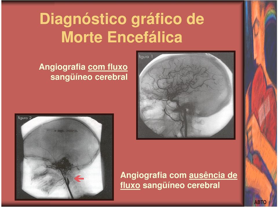 sangüíneo cerebral Angiografia