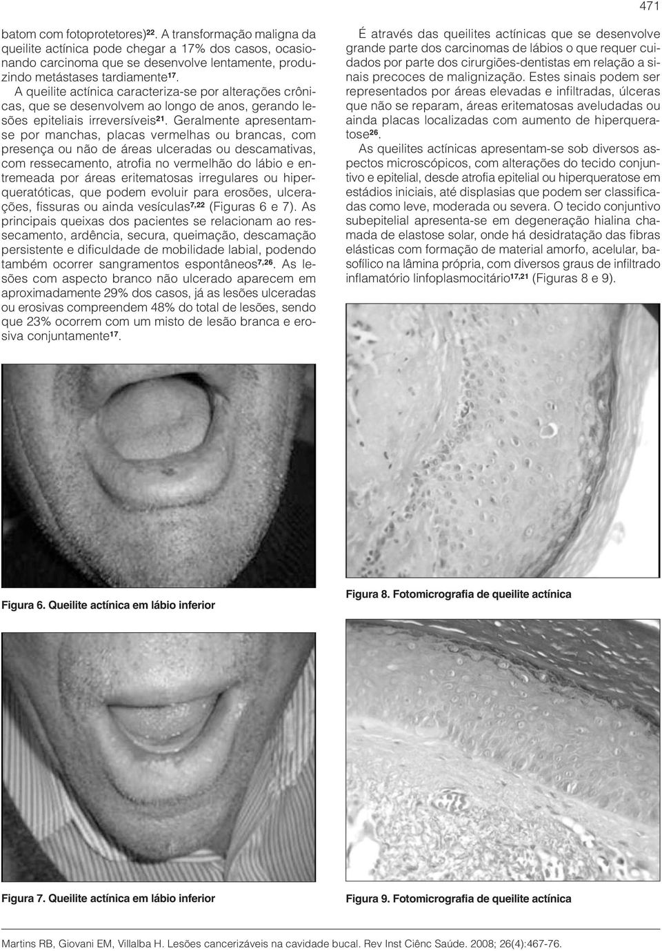 Geralmente apresentamse por manchas, placas vermelhas ou brancas, com presença ou não de áreas ulceradas ou descamativas, com ressecamento, atrofia no vermelhão do lábio e entremeada por áreas