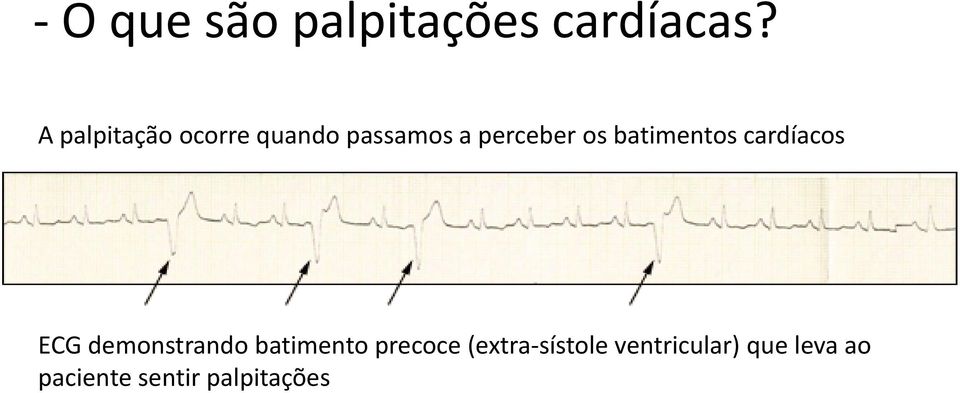 batimentos cardíacos ECG demonstrando batimento