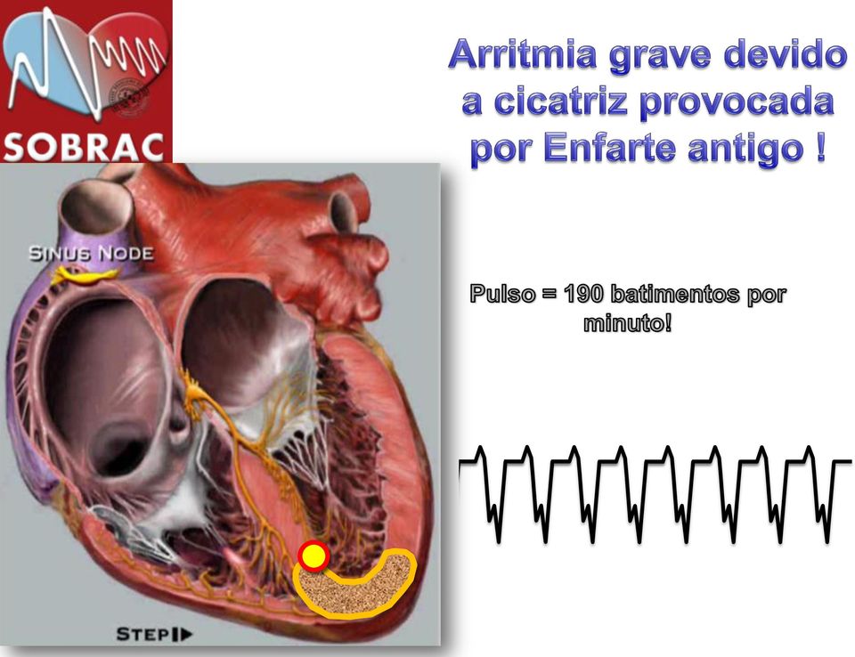 Arritmias de Cardíacas