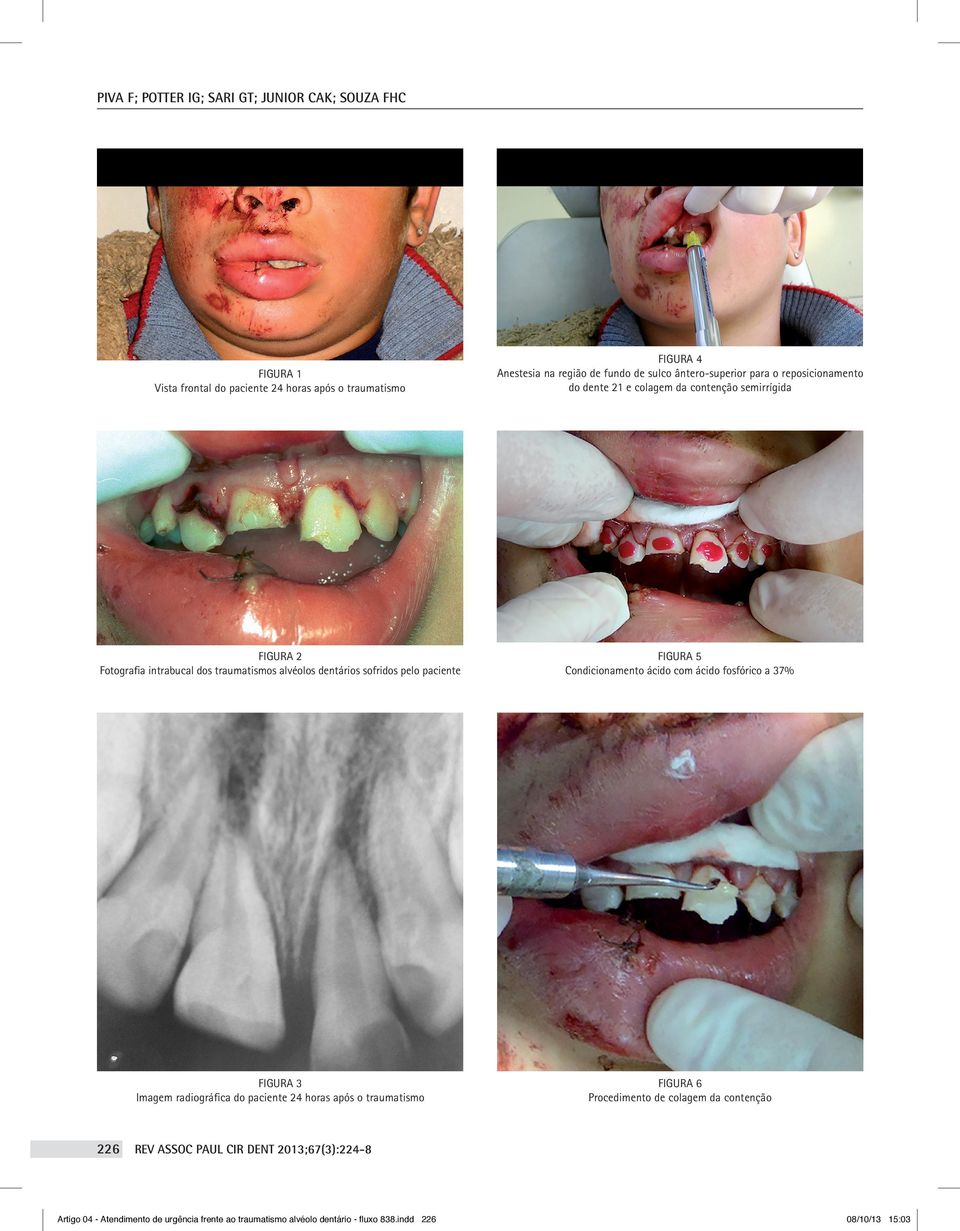 dentários sofridos pelo paciente figura 5 Condicionamento ácido com ácido fosfórico a 37% figura 3 Imagem radiográfica do paciente 24 horas após o