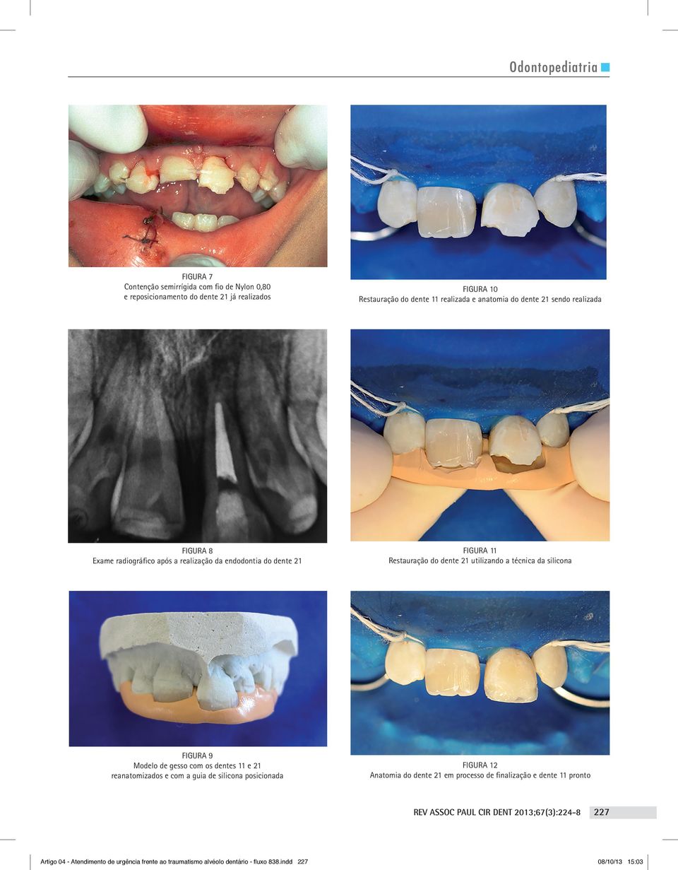 utilizando a técnica da silicona figura 9 Modelo de gesso com os dentes 11 e 21 reanatomizados e com a guia de silicona posicionada figura 12 Anatomia do