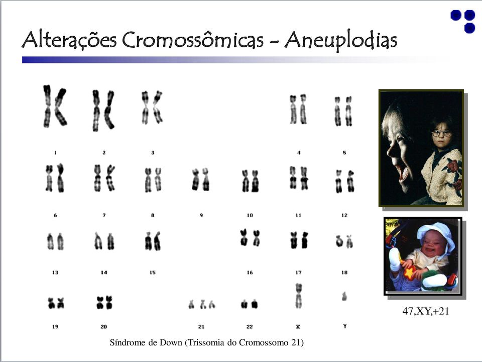 Aneuplodias 47,XY,+21