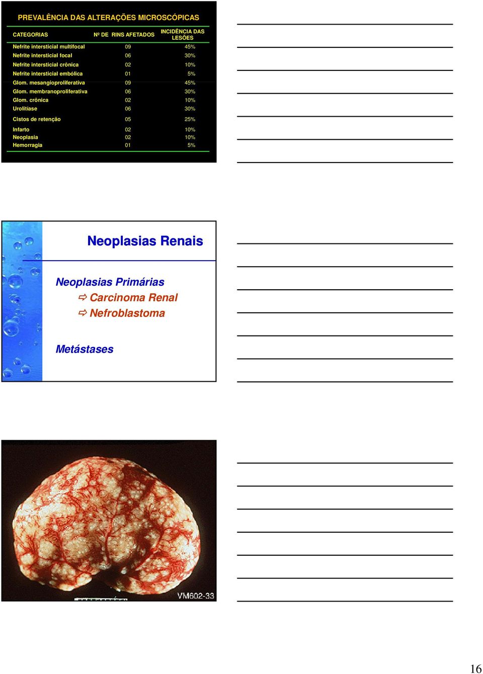 mesangioproliferativa 09 45% Glom. membranoproliferativa 06 30% Glom.