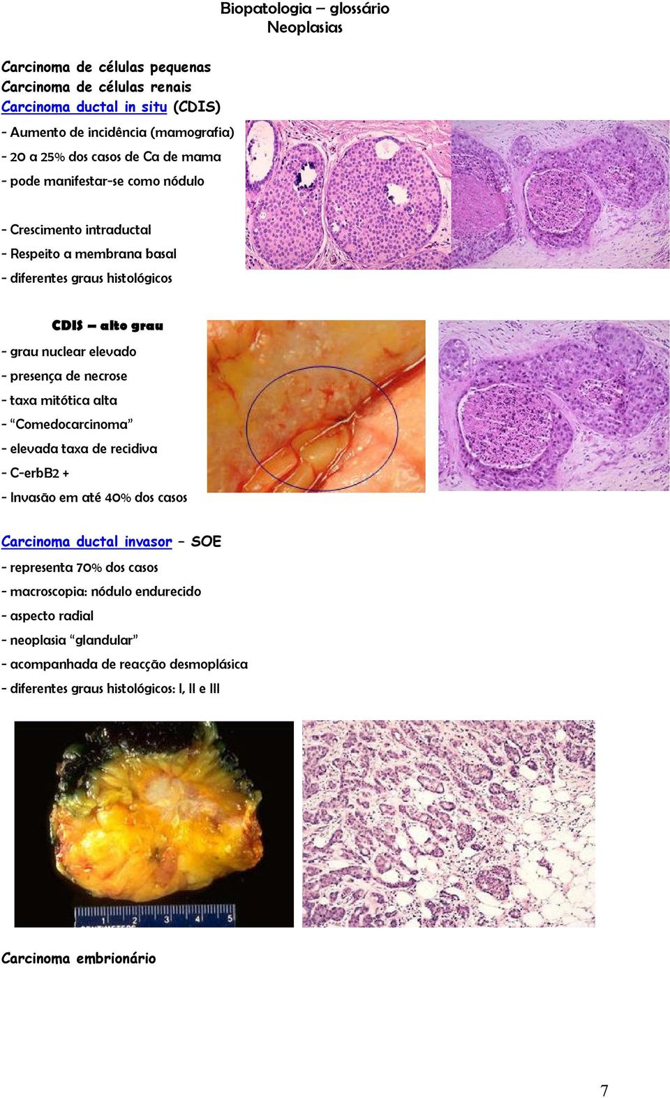 presença de necrose - taxa mitótica alta - Comedocarcinoma - elevada taxa de recidiva - C-erbB2 + - Invasão em até 40% dos casos Carcinoma ductal invasor SOE - representa 70%