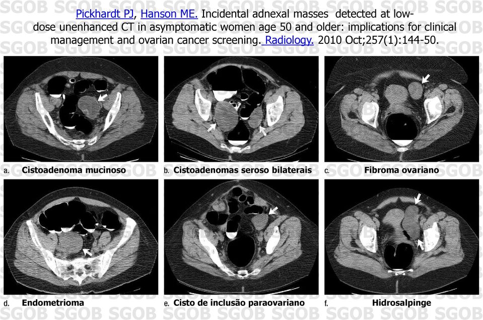 and older: implications for clinical management and ovarian cancer screening. Radiology.