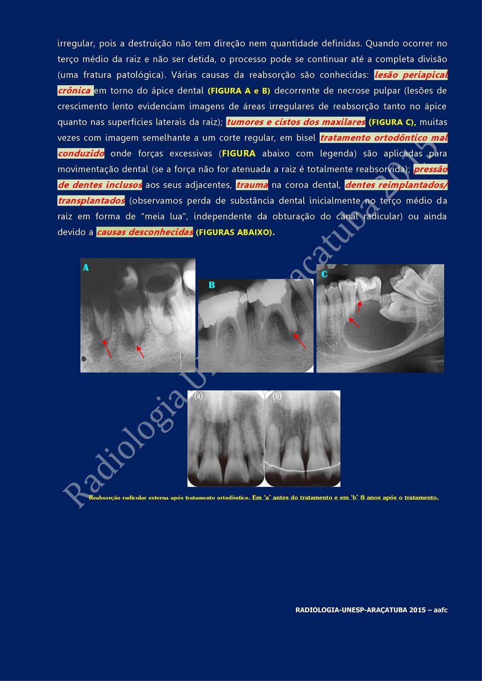 Várias causas da reabsorção são conhecidas: lesão periapical crônica em torno do ápice dental (FIGURA A e B) decorrente de necrose pulpar (lesões de crescimento lento evidenciam imagens de áreas