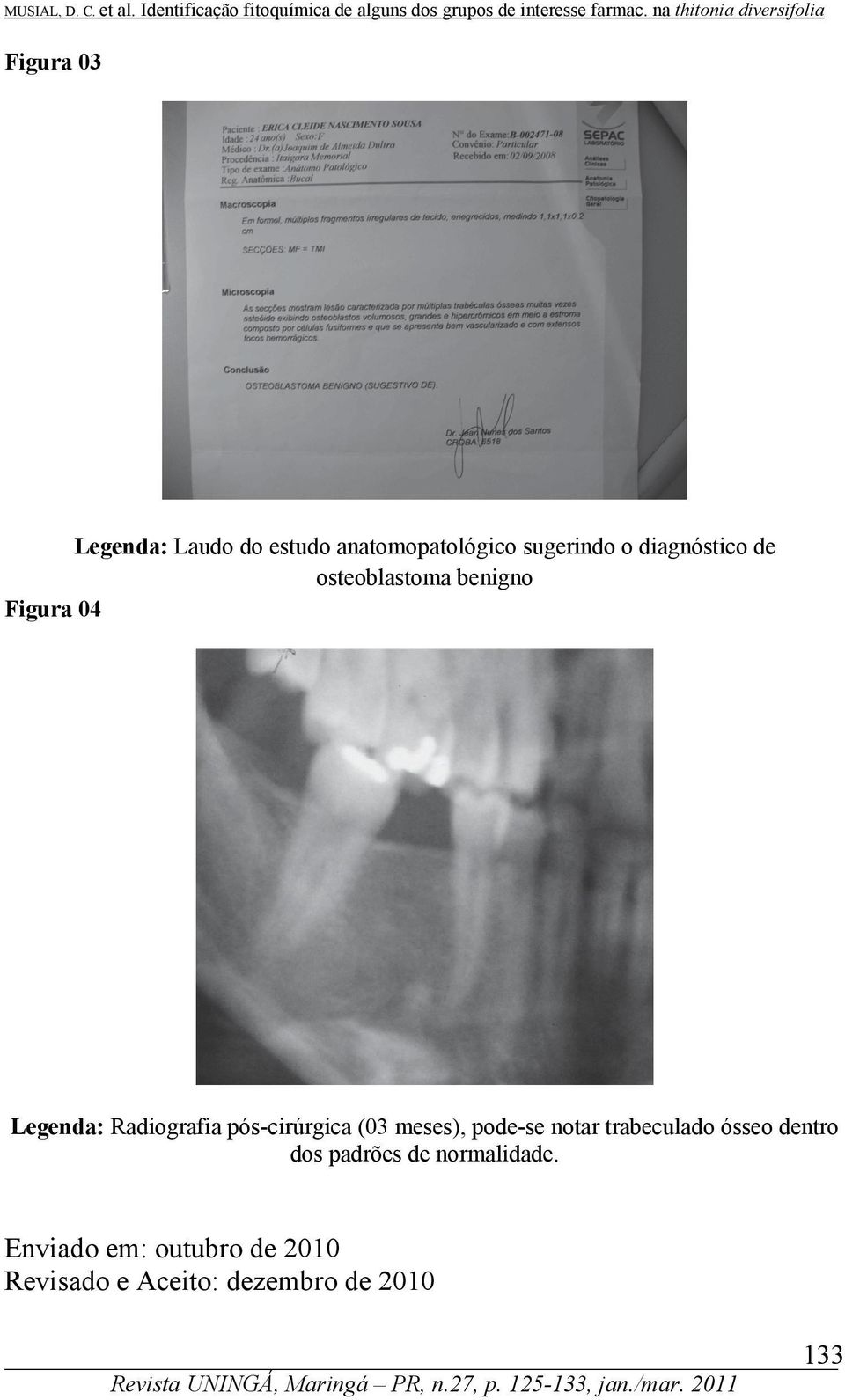 de osteoblastoma benigno Figura 04 Legenda: Radiografia pós-cirúrgica (03 meses), pode-se notar