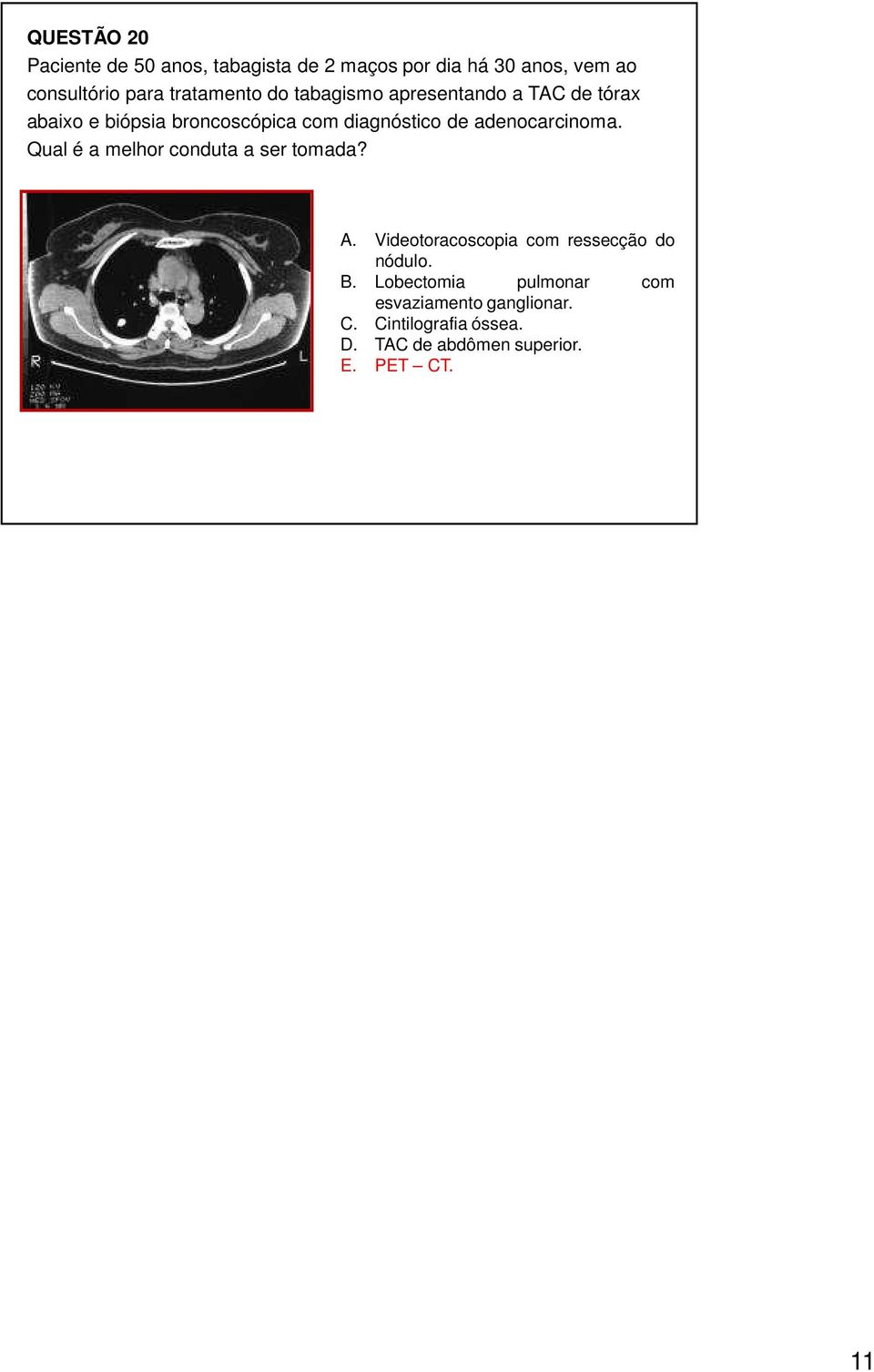 adenocarcinoma. Qual é a melhor conduta a ser tomada? A. Videotoracoscopia com ressecção do nódulo. B.