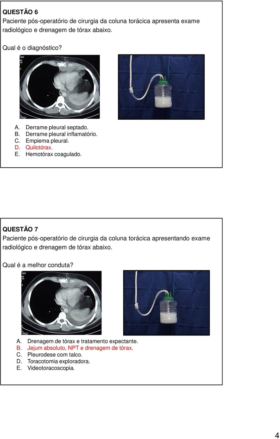 QUESTÃO 7 Paciente pós-operatório de cirurgia da coluna torácica apresentando exame radiológico e drenagem de tórax abaixo.