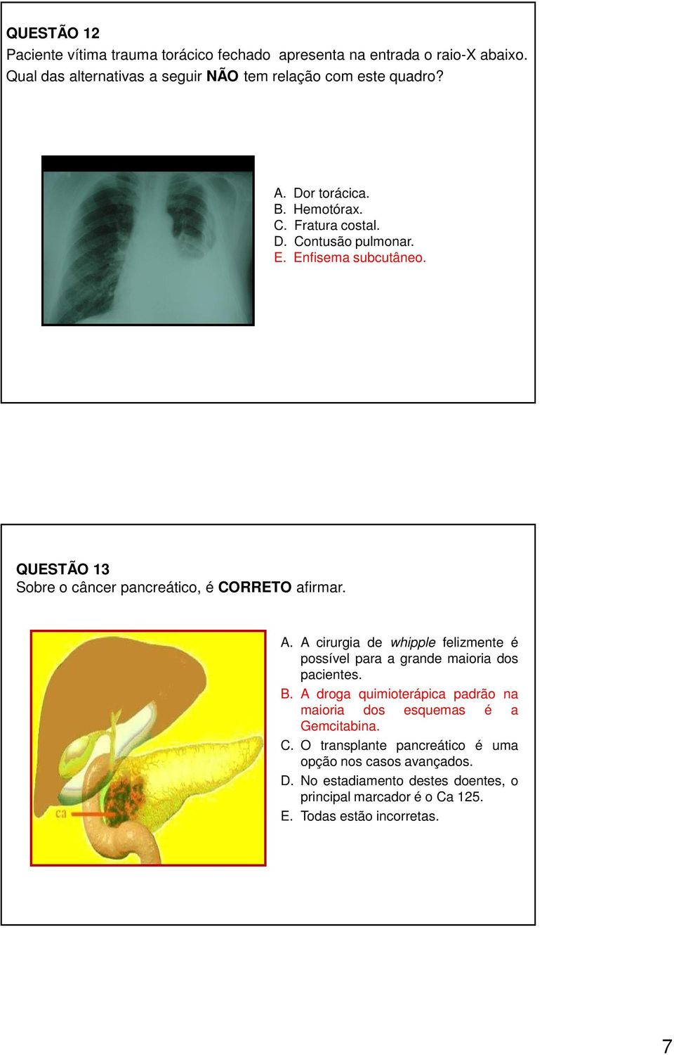 A cirurgia de whipple felizmente é possível para a grande maioria dos pacientes. B. A droga quimioterápica padrão na maioria dos esquemas é a Gemcitabina.