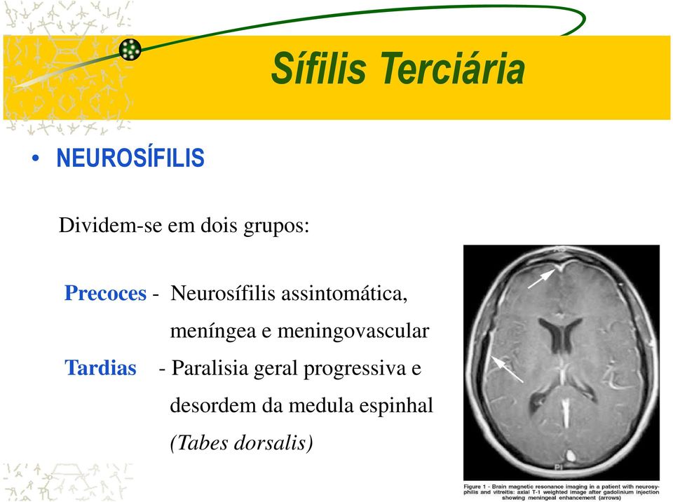 meníngea e meningovascular Tardias - Paralisia