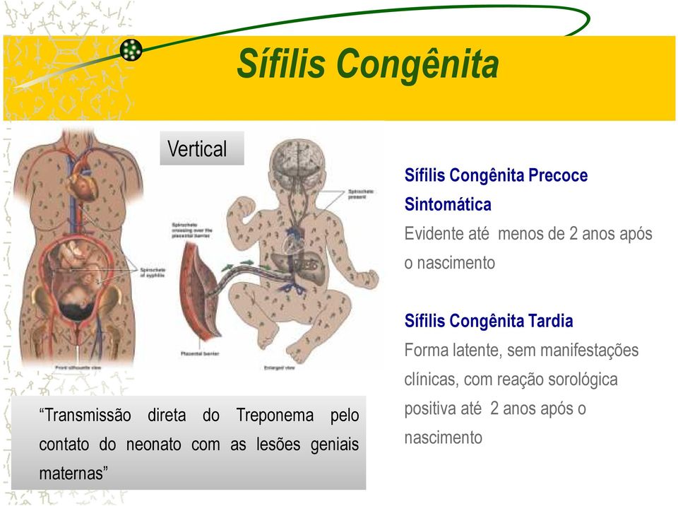 neonato com as lesões geniais maternas Sífilis Congênita Tardia Forma latente,