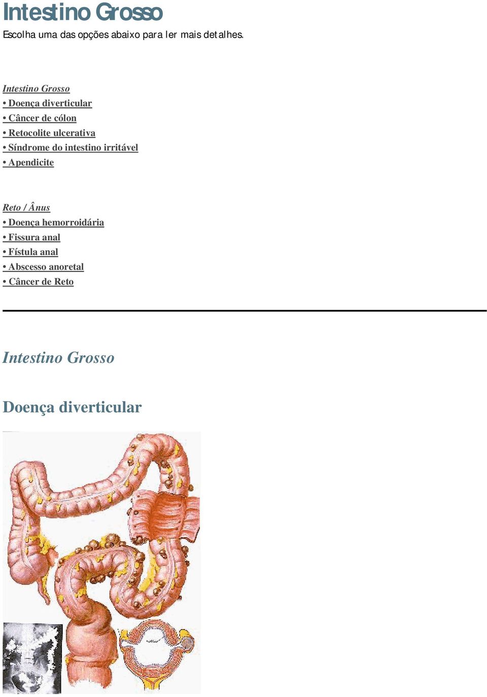 Síndrome do intestino irritável Apendicite Reto / Ânus Doença hemorroidária